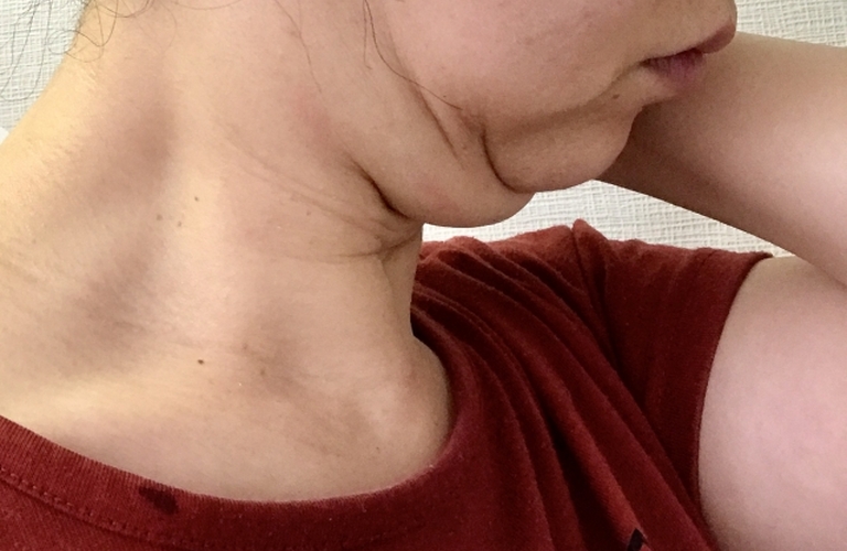 これで解決！！ストレートネックと二重アゴの関係性/池袋で通わせない整骨院ならreborn鍼灸整骨院